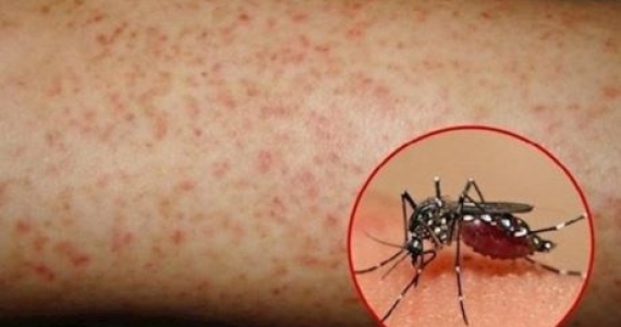 Sốt phát ban khác sốt xuất huyết như thế nào?